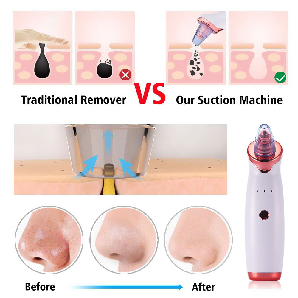 Electric Blackhead Remover Vacuum – Deep Pore Cleaner